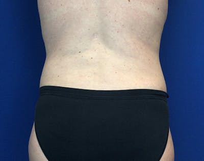 Liposuction Before & After Gallery - Patient 191224 - Image 6