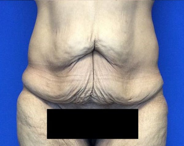 Tummy Tuck (Abdominoplasty) Before & After Gallery - Patient 854946 - Image 1