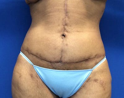 Tummy Tuck (Abdominoplasty) Before & After Gallery - Patient 854946 - Image 2