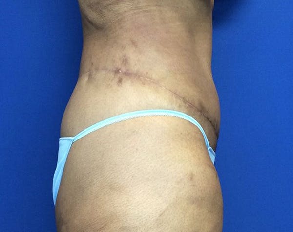 Tummy Tuck (Abdominoplasty) Before & After Gallery - Patient 854946 - Image 4