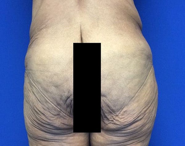 Tummy Tuck (Abdominoplasty) Before & After Gallery - Patient 854946 - Image 5