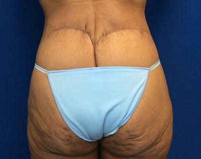 Tummy Tuck (Abdominoplasty) Before & After Gallery - Patient 854946 - Image 6