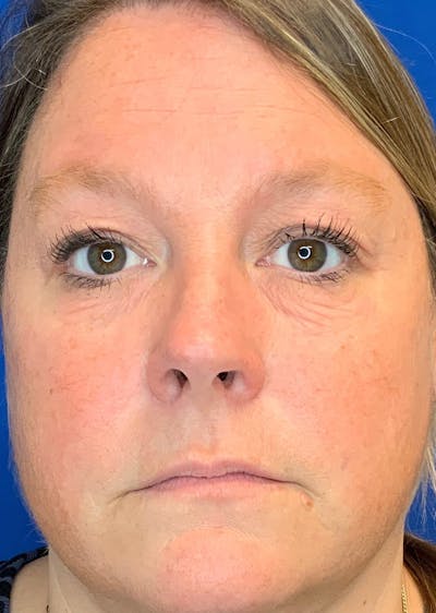 Laser Skin Resurfacing Before & After Gallery - Patient 281935 - Image 1