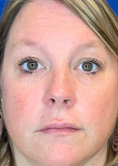 Laser Skin Resurfacing Before & After Gallery - Patient 281935 - Image 2