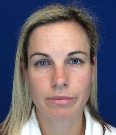 Liposuction Before & After Gallery - Patient 165601 - Image 1