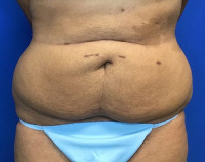 Tummy Tuck (Abdominoplasty) Before & After Gallery - Patient 365212 - Image 1
