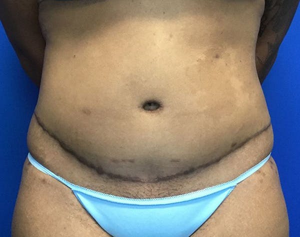 Tummy Tuck (Abdominoplasty) Before & After Gallery - Patient 365212 - Image 2