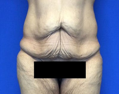 Post Bariatric Before & After Gallery - Patient 371501 - Image 1