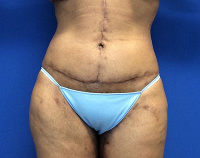 Post Bariatric Before & After Gallery - Patient 371501 - Image 2