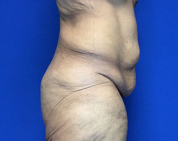 Post Bariatric Before & After Gallery - Patient 371501 - Image 3