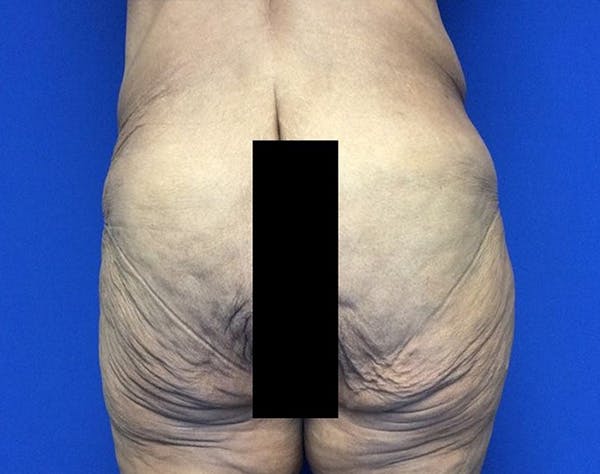 Post Bariatric Before & After Gallery - Patient 371501 - Image 5