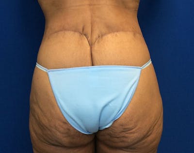 Post Bariatric Before & After Gallery - Patient 371501 - Image 6