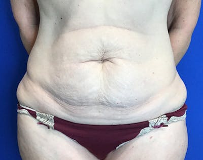 Tummy Tuck (Abdominoplasty) Before & After Gallery - Patient 240504 - Image 1