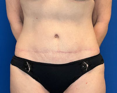 Tummy Tuck (Abdominoplasty) Before & After Gallery - Patient 240504 - Image 2