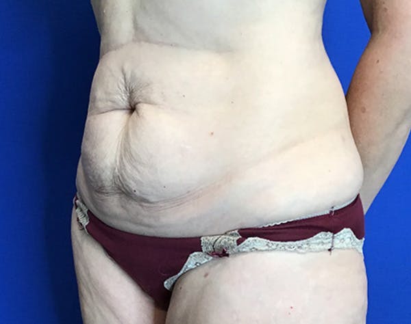 Tummy Tuck (Abdominoplasty) Before & After Gallery - Patient 240504 - Image 3