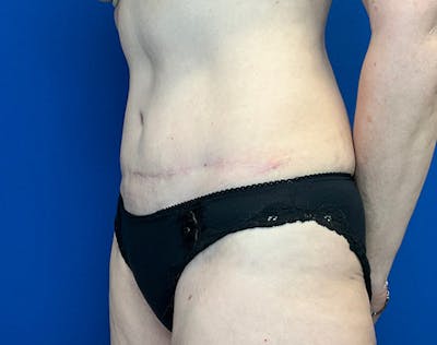 Tummy Tuck (Abdominoplasty) Before & After Gallery - Patient 240504 - Image 4