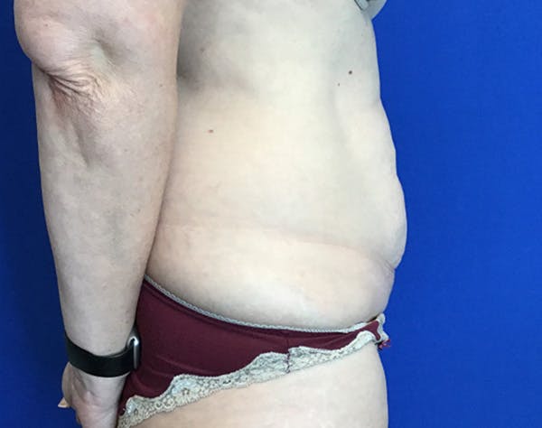 Liposuction Before & After Gallery - Patient 235361 - Image 5