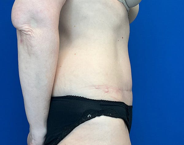 Liposuction Before & After Gallery - Patient 235361 - Image 6
