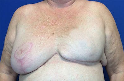 Breast Implant Reconstruction Before & After Gallery - Patient 224748 - Image 1