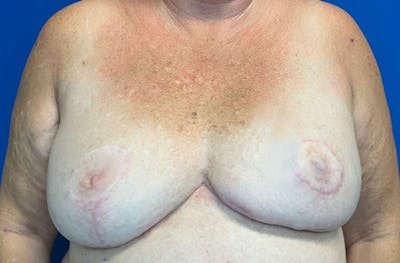 Breast Implant Reconstruction Before & After Gallery - Patient 224748 - Image 2