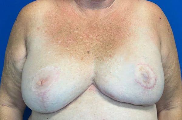 Breast Implant Reconstruction Before & After Gallery - Patient 224748 - Image 2