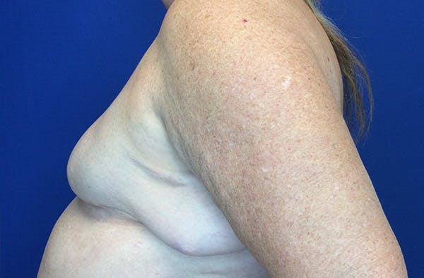 Breast Implant Reconstruction Before & After Gallery - Patient 224748 - Image 3