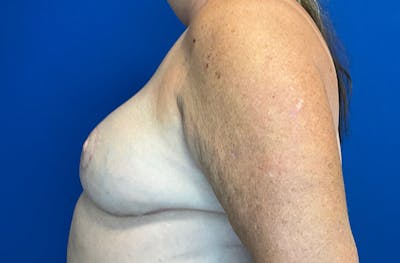 Breast Implant Reconstruction Before & After Gallery - Patient 224748 - Image 4