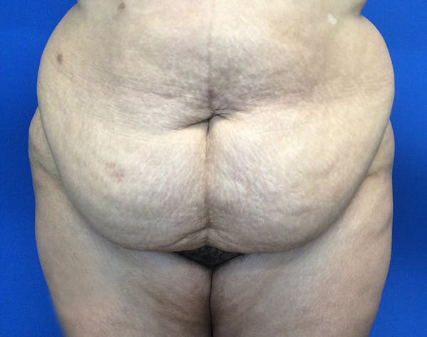 Tummy Tuck (Abdominoplasty) Before & After Gallery - Patient 141182 - Image 1