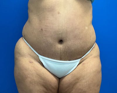 Tummy Tuck (Abdominoplasty) Before & After Gallery - Patient 141182 - Image 2