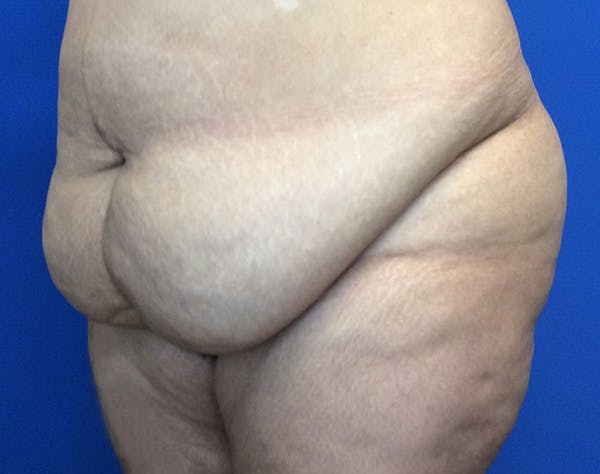 Tummy Tuck (Abdominoplasty) Before & After Gallery - Patient 141182 - Image 3