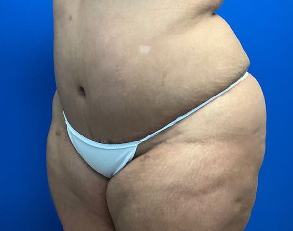 Tummy Tuck (Abdominoplasty) Before & After Gallery - Patient 141182 - Image 4
