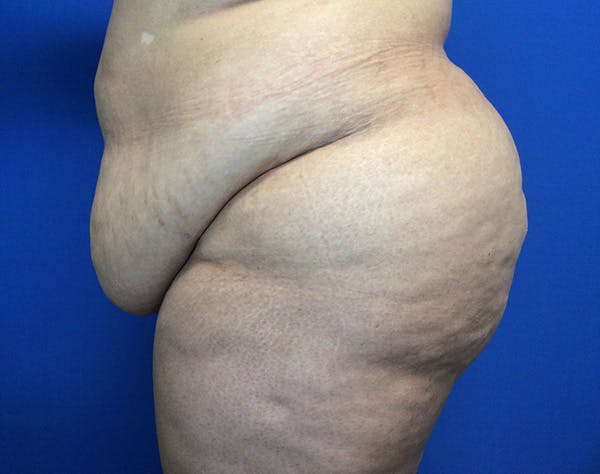 Tummy Tuck (Abdominoplasty) Before & After Gallery - Patient 141182 - Image 5