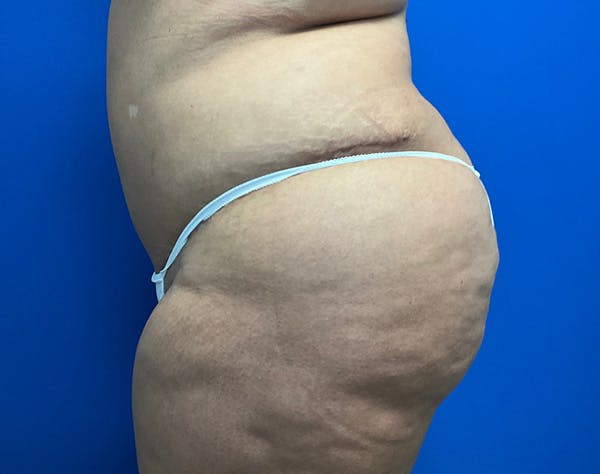 Tummy Tuck (Abdominoplasty) Before & After Gallery - Patient 141182 - Image 6