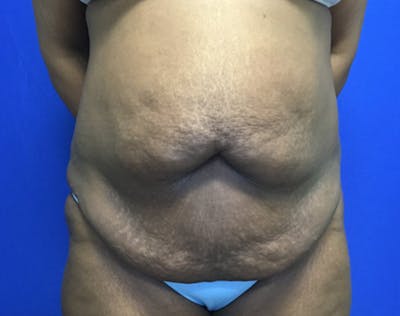 Tummy Tuck (Abdominoplasty) Before & After Gallery - Patient 171932 - Image 1