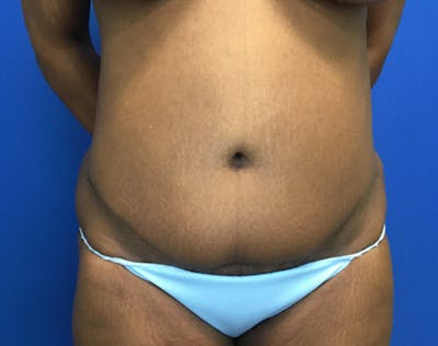Tummy Tuck (Abdominoplasty) Before & After Gallery - Patient 171932 - Image 2