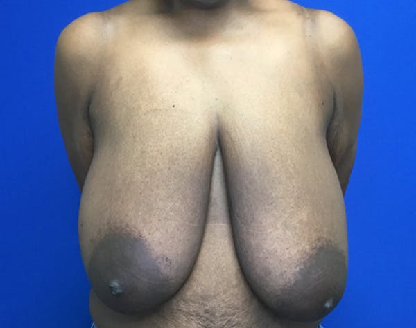 Breast Reduction Before & After Gallery - Patient 409679 - Image 1