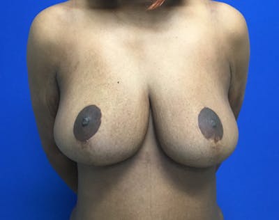 Breast Reduction Before & After Gallery - Patient 409679 - Image 2