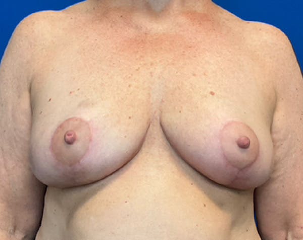 Breast Reduction Before & After Gallery - Patient 139446 - Image 2
