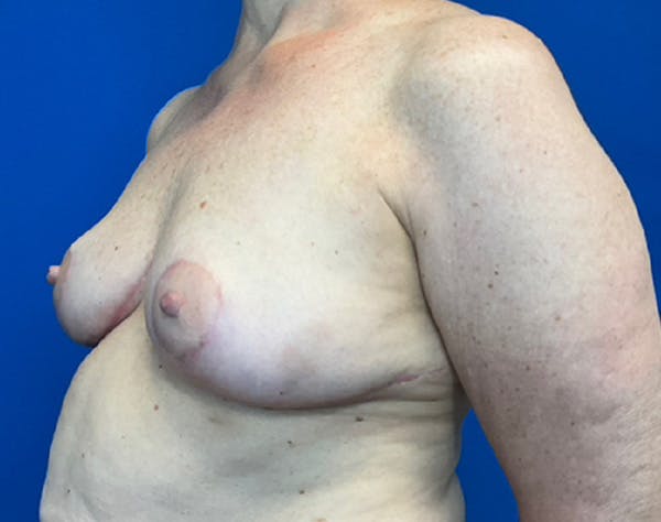 Breast Reduction Before & After Gallery - Patient 139446 - Image 4