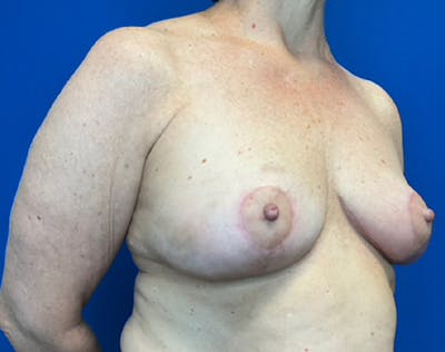 Breast Reduction Before & After Gallery - Patient 139446 - Image 6