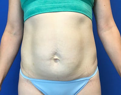 Tummy Tuck (Abdominoplasty) Before & After Gallery - Patient 356396 - Image 1