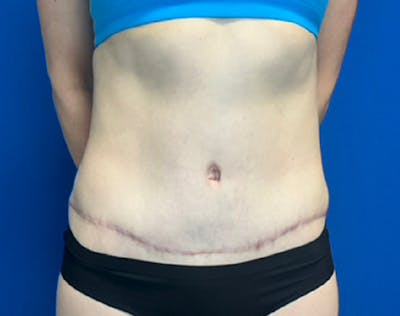 Tummy Tuck (Abdominoplasty) Before & After Gallery - Patient 356396 - Image 2