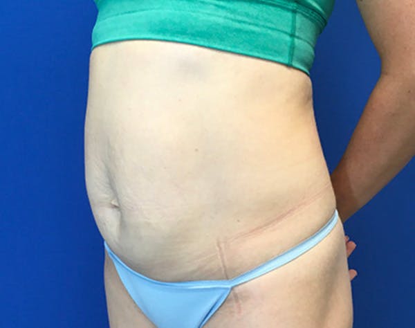 Tummy Tuck (Abdominoplasty) Before & After Gallery - Patient 356396 - Image 3