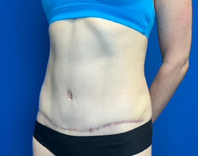 Liposuction Before & After Gallery - Patient 338384 - Image 4