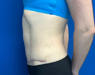 Liposuction Before & After Gallery - Patient 338384 - Image 6