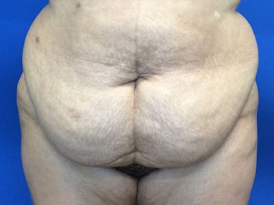 Tummy Tuck (Abdominoplasty) Before & After Gallery - Patient 675461 - Image 1