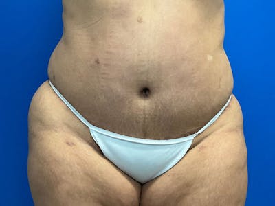 Tummy Tuck (Abdominoplasty) Before & After Gallery - Patient 675461 - Image 2