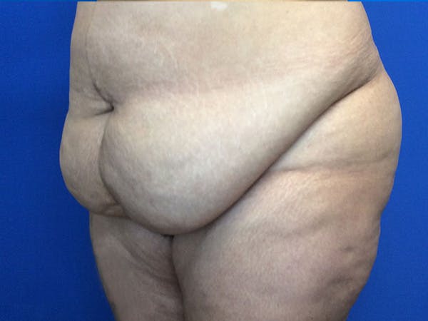 Tummy Tuck (Abdominoplasty) Before & After Gallery - Patient 675461 - Image 3