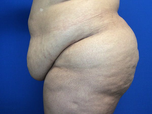 Tummy Tuck (Abdominoplasty) Before & After Gallery - Patient 675461 - Image 5