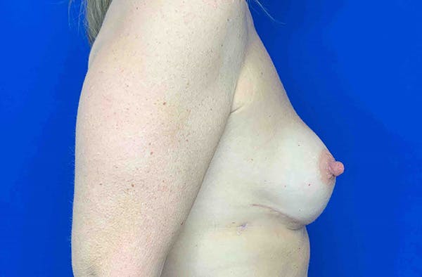 Breast Implant Reconstruction Before & After Gallery - Patient 245438 - Image 4